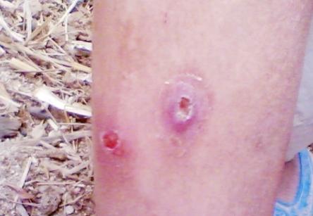 الاصابة البشرية بالدودة الحلزونية